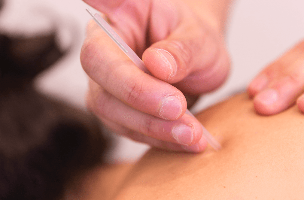 Técnica de punción seca