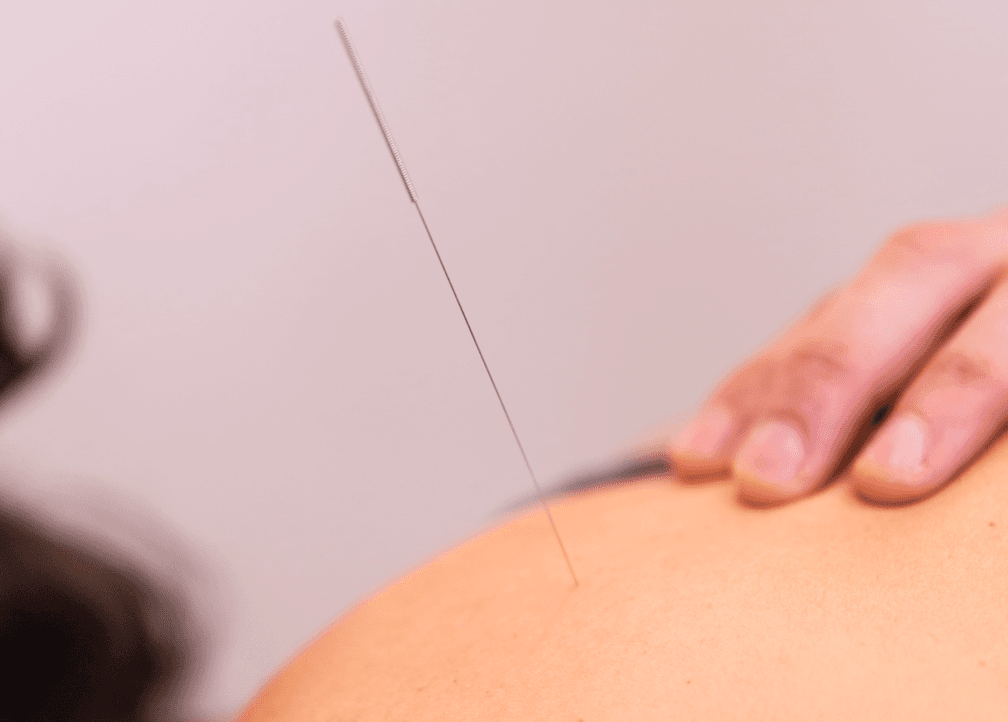 Neuromodulación invasiva